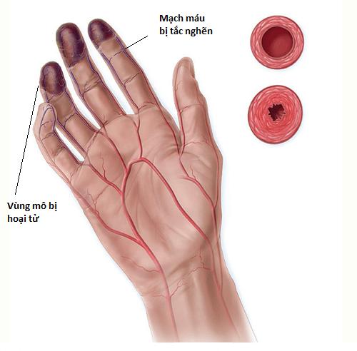 Buerger - viêm thuyên tắc mạch máu
