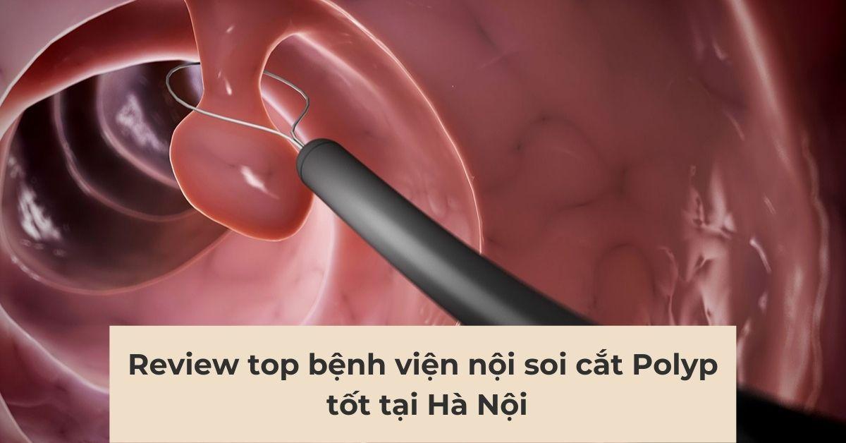 Nội soi cắt polyp giúp dễ dàng cắt bỏ các polyp bên trong