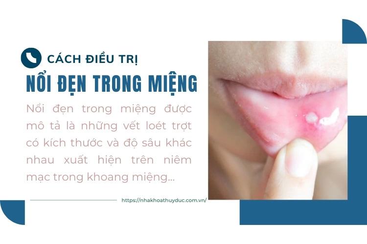 Nổi đẹn trong miệng là gì? Cách điều trị! 1