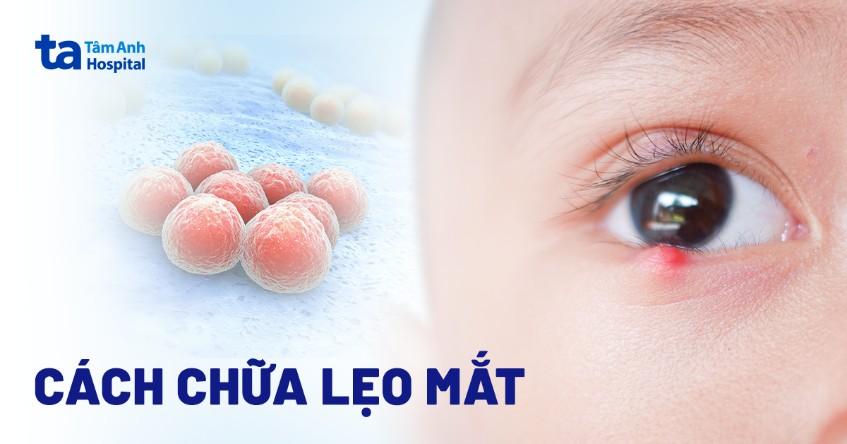 11 cách chữa lẹo mắt an toàn, hiệu quả và điều trị tại nhà