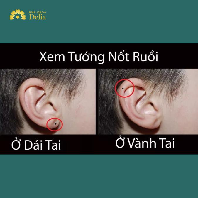 Vị Trí Nốt Ruồi Ở Tai Nam Nữ Nói Lên Điều Gì?