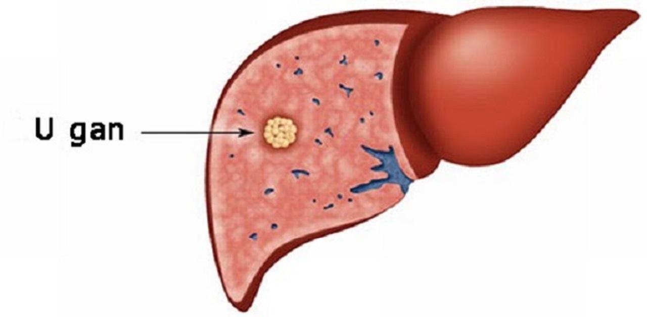 U gan lành tính là gì? Những điều cần biết về u gan lành tính