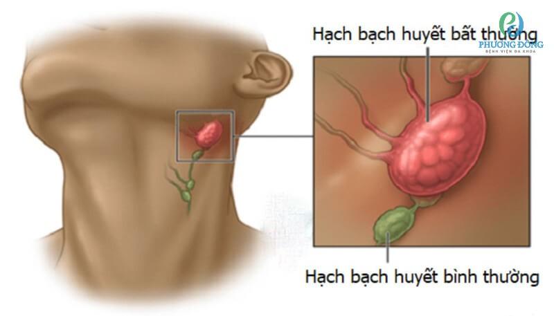 7 phương pháp điều trị ung thư hạch bạch huyết phổ biến hiện nay