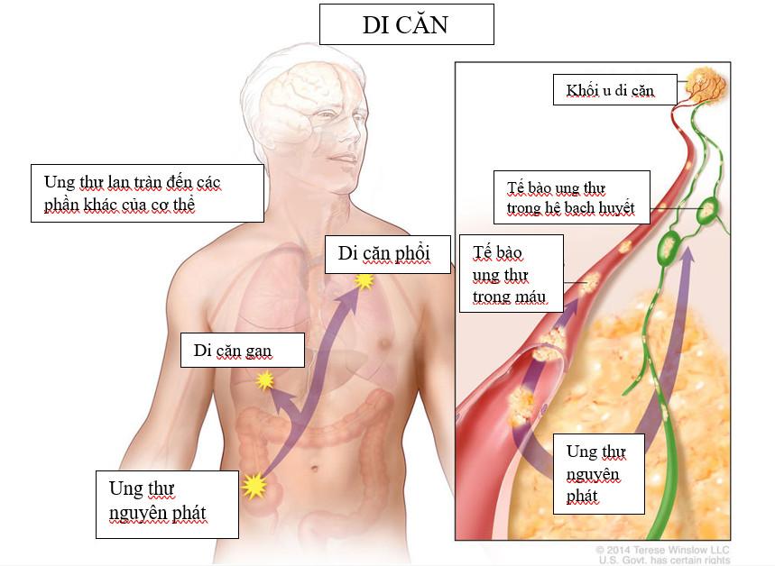 Ung thư di căn là gì? Các tế bào di căn như thế nào và dấu hiệu