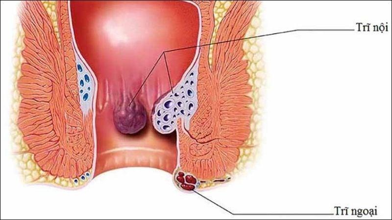 Bệnh trĩ gồm 2 loại trĩ nội và trĩ ngoại