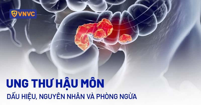 ung thư hậu môn